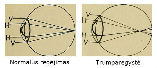 Normalus regėjimas vs. Trumparegystė